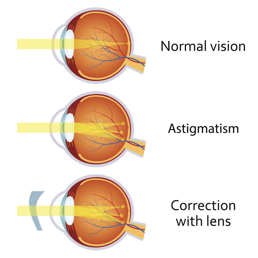 Astigmatism Treatments at Pacific Vision Institute