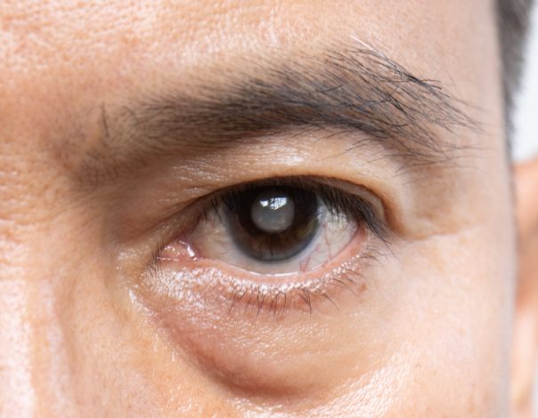 Man with cataracts